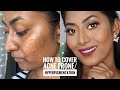 HOW TO COVER ACNE PRONE SKIN & HYPERPIGMENTATION ✨ ft. SUGAR COSMETICS