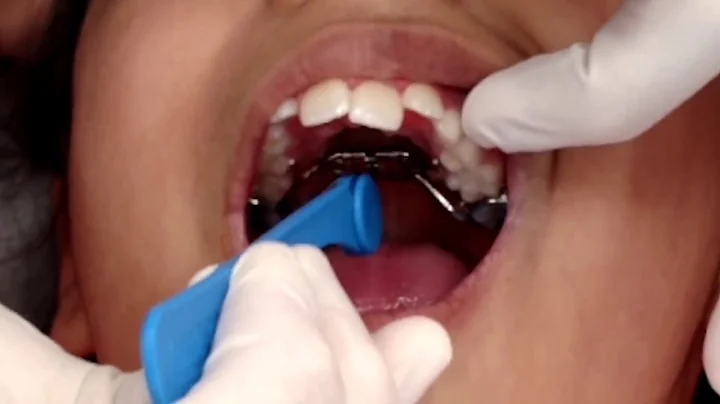 Palate Expander turning