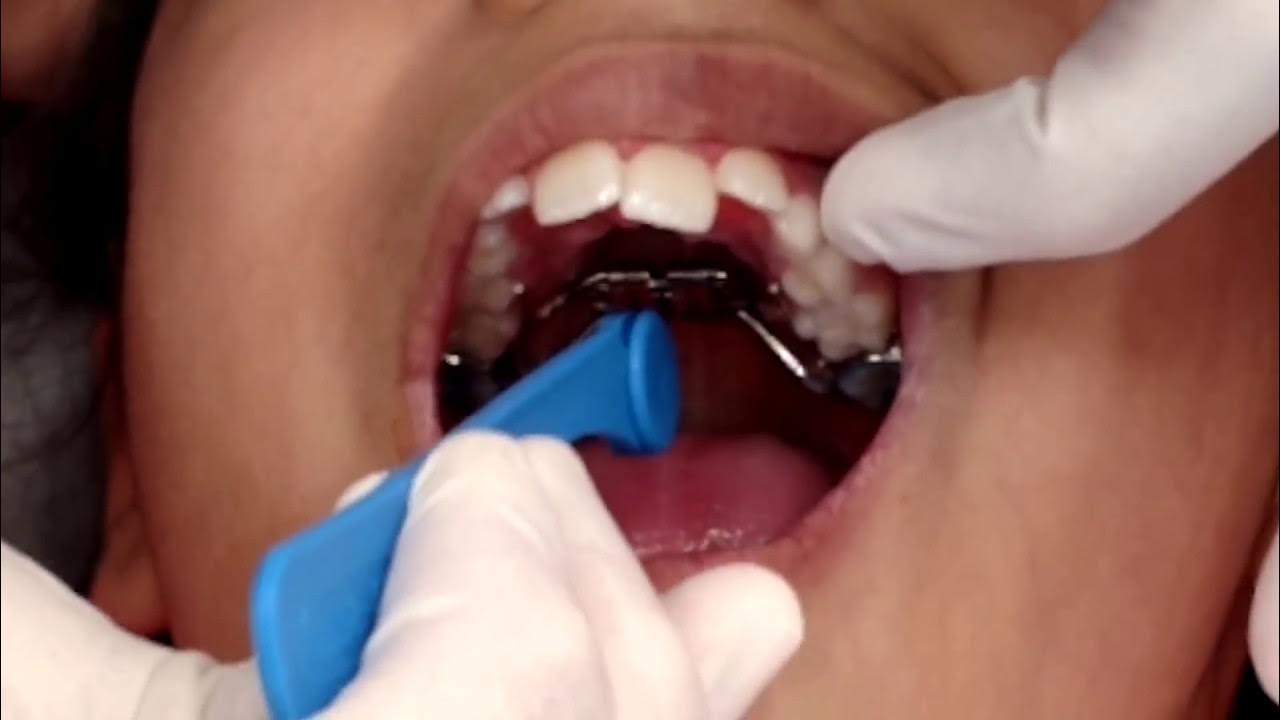 Palate Expander turning YouTube