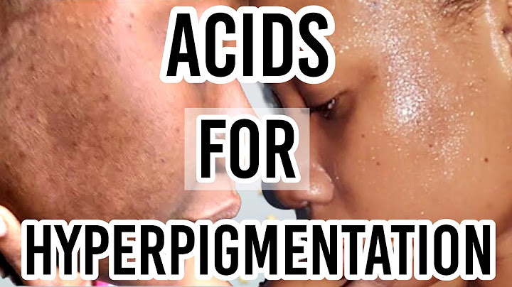 Which acid is best for acne scars and dark spots?
