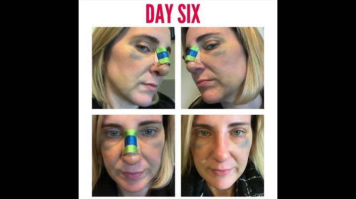 Rhinoplasty Recovery Day By Day