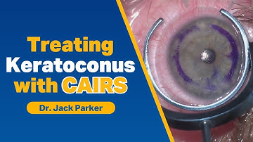 Treating Keratoconus with CAIRS - Surgical Video of CAIRS Insertion