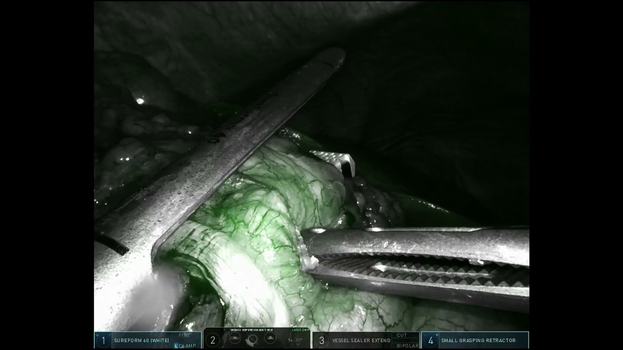 Robotic Right Hemicolectomy 2021