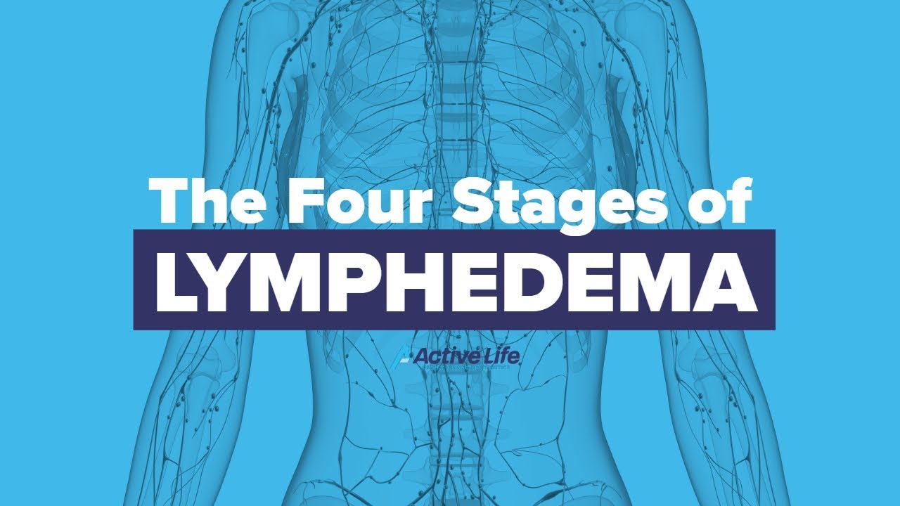 Stages Of Lymphedema Youtube