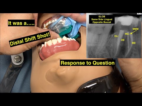 Dental Xrays - SLOB Rule - Distal Shift Shot - Demonstration With Dextor And Response To Video