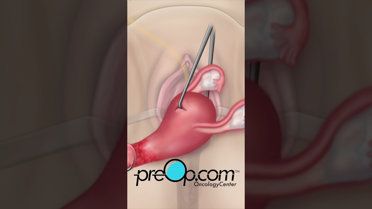 PreOp&reg; 🌷 Vaginal Hysterectomy Prep Checklist! #preop #shorts #health 🖊️