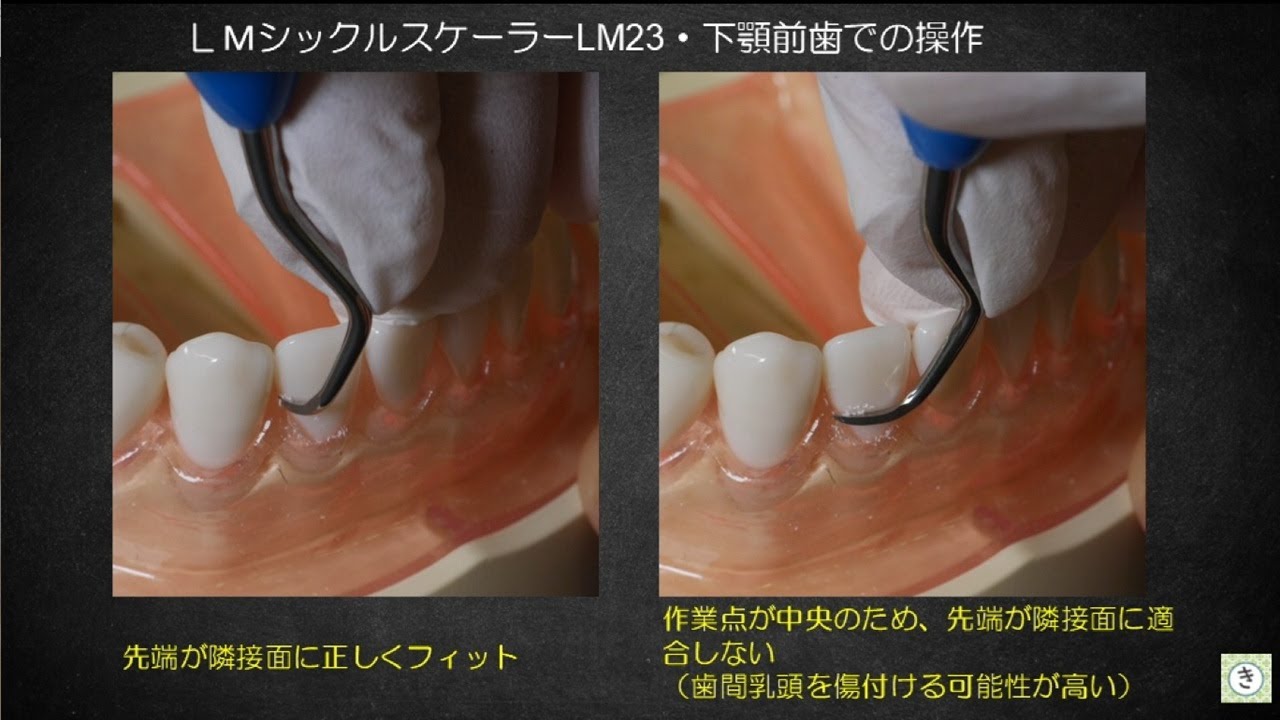 歯科衛生士のための基本の「き」の時間No.5～シックル型スケーラー