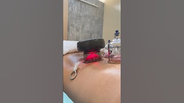 Heated muscle scraping tool combines cupping device for back recovery. #massagetherapy