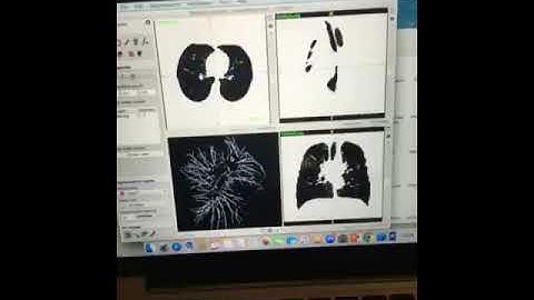 Lung Vessel Segmentation
