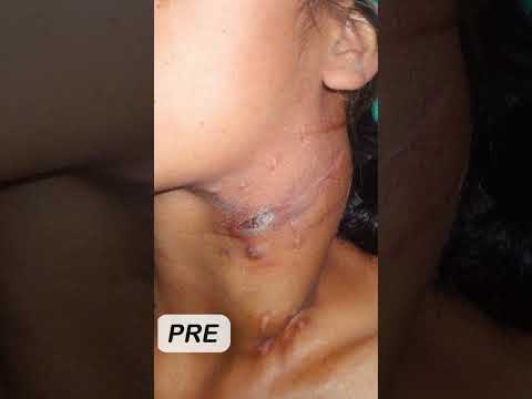 Thyroid Cancer Surgery Dr. Sudhi A. Kamboj Meerut