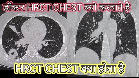 Why do doctors do HRCT Chest // CT chest symptoms # HRCT Chest # Why should CT chest be done