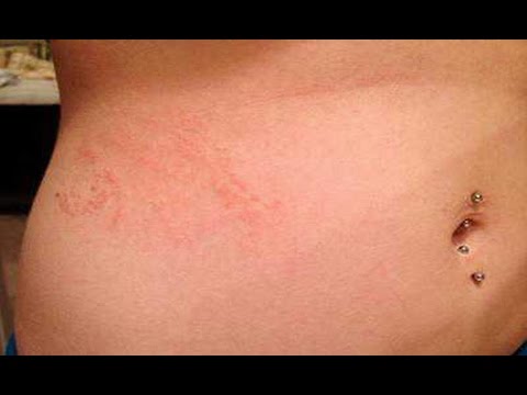 scabies itching after treatment #10