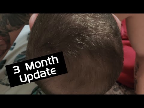 hair-transplant-3-month-update-|-no-fin-|-dr-cinik-instanbul-turkey