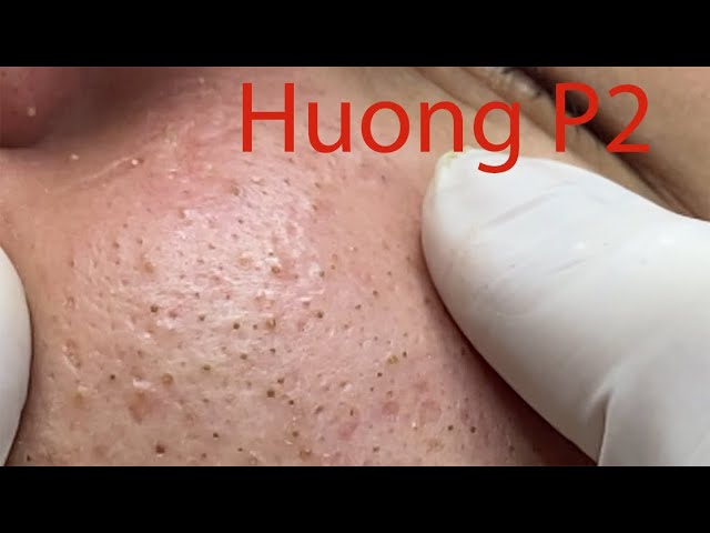Make your Acne Treatment Huong Da Nang#490 part 2 | acne 2022