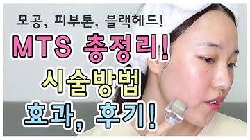 MTS시술 총 정리, 방법, 효과, 후기까지! 직접 MTS 했어요~