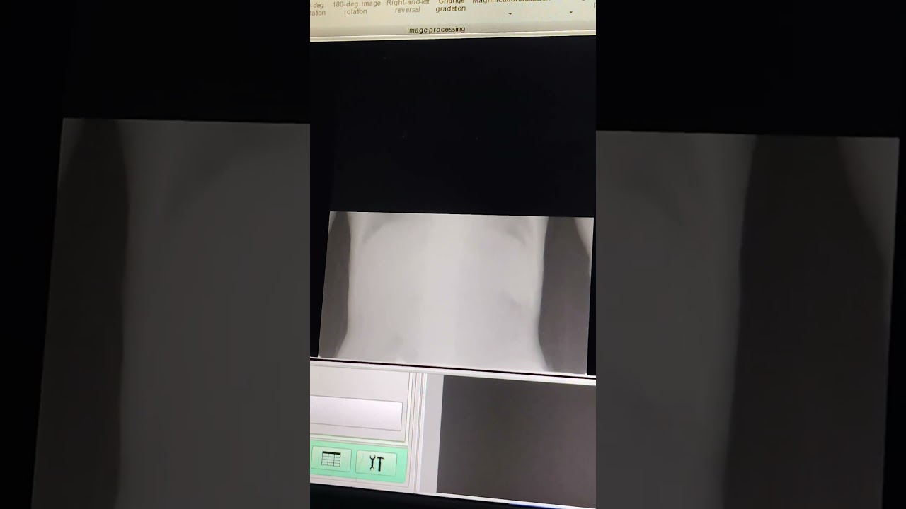 Chest PA x- ray view Standing 