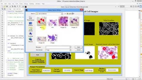 Matlab Code for Early Stage Blood Cancer Detection Using Image Processing