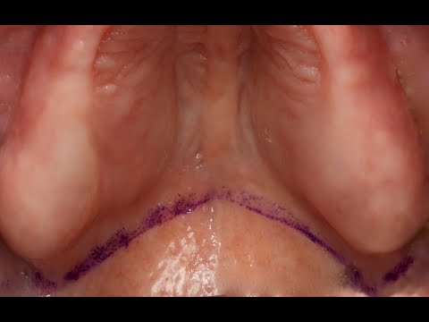 حافة طقم الأسنان الخلفي العلوي والختم الحنكي الخلفي