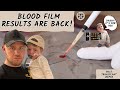 The blood film results are back ep48