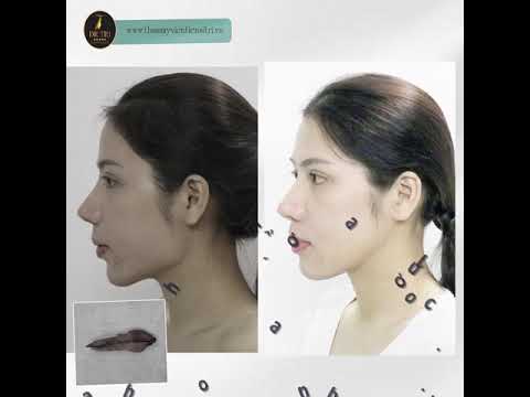 Gọt Hàm V line - Trượt Cằm tại Thẩm Mỹ Viện Tiến Sĩ Trí ( Sau 10 Ngày ) Gọt Hàm V line - Trượt Cằm tại Thẩm Mỹ Viện Tiến Sĩ Trí ( Sau 10 Ngày )