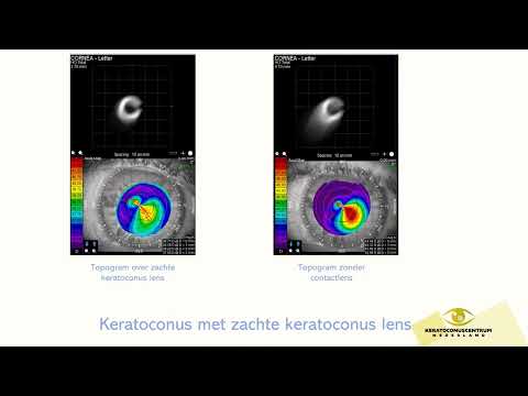 Zachte keratoconus lenzen met Conepower technologie