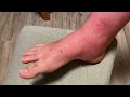 Why is my foot and leg extremely swollen? what to do after a black fly bite