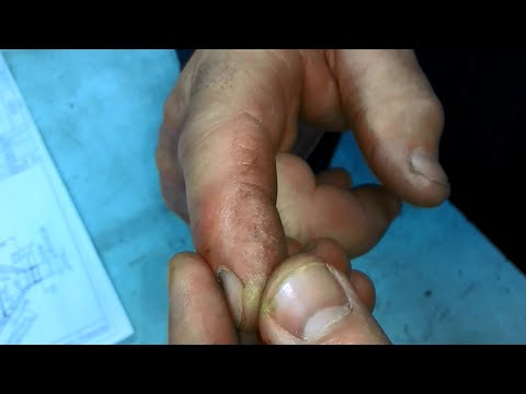 Видео: Как удалить занозу под ногтем: 10 шагов