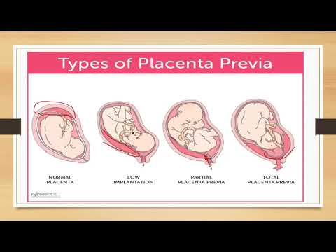 Video: Placenta Previa. Ախտորոշում, բուժում, հետևանքներ