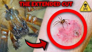 BROWN RECLUSE BITE? What happens? THE EXTENDED CUT!