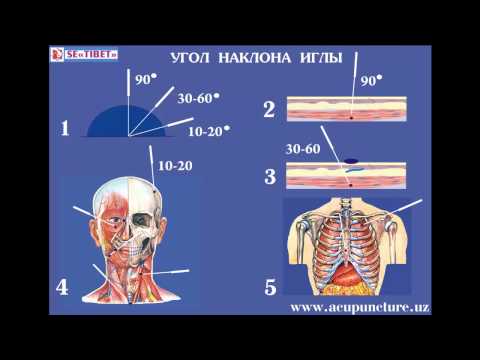 Видео: Акупунктура - рецензии, видове, приложение