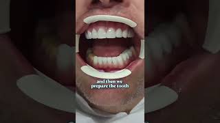 Dental Crown Process