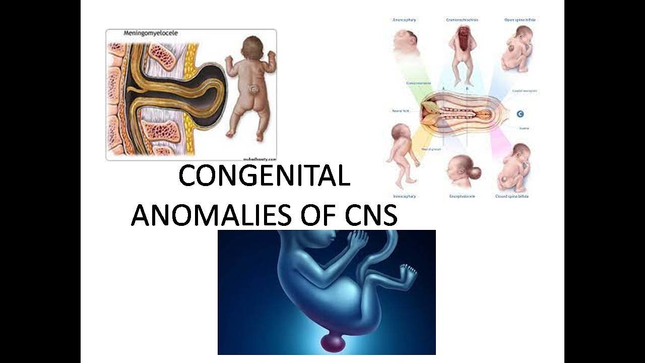 CONGENITAL ANOMALIES OF CNS CENTRAL NERVOUS SYSTEM ANOMALIES YouTube congenital-anomalies-of-cns-central-nervous-system-anomalies-youtube