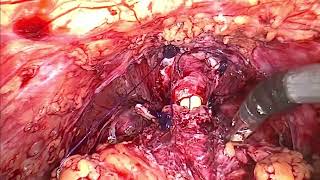 HandX - Radical prostatectomy