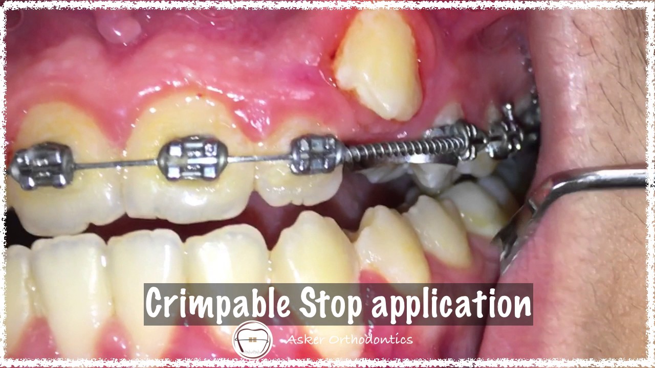 Crimpable Hook in Orthodontics 