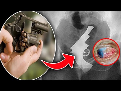 Crazy Things Found Inside Human Body | Human Body | Crazy FACTS