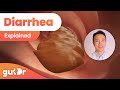 Diarrhea  explained by dr vincent ho 3d gut animation