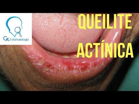 Vídeo: Queilite Nos Lábios - Classificação, Tratamento