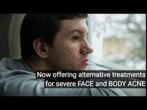 Severe Acne- Face & Body