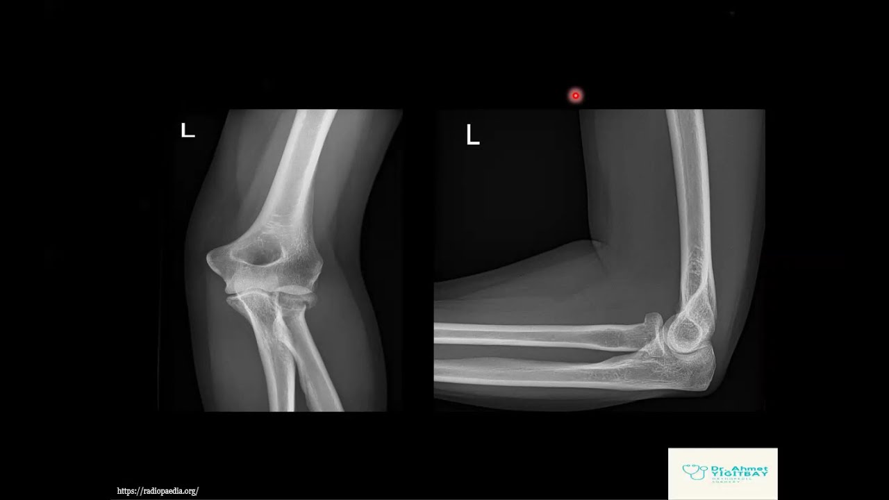 Erişkin Dirsek Röntgeni Yorumlama Teknikleri
