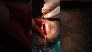 Apicoectomy | Root End Resection🦷. #shorts #shortsfeed #ytshorts #epicoectomy #rootendresection