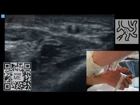 Video: Arteriel Hypertension - Behandling, Forebyggelse, Grad, Fase