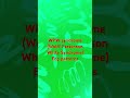 WPW Syndrome Wolff Parkinson White Syndrome Part 2 WPW Syndrome Wolff Parkinson White Syndrome Part 2