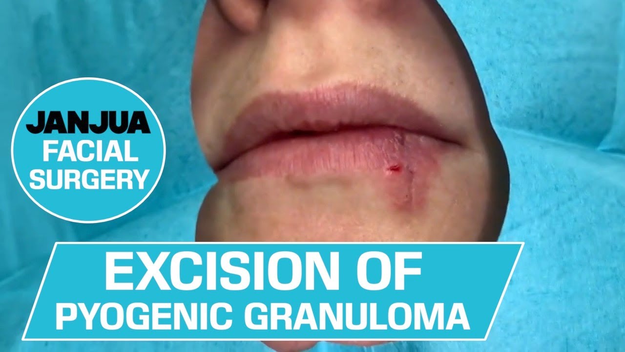 excision-of-pyogenic-granuloma-on-the-lip-during-pregnancy-dr