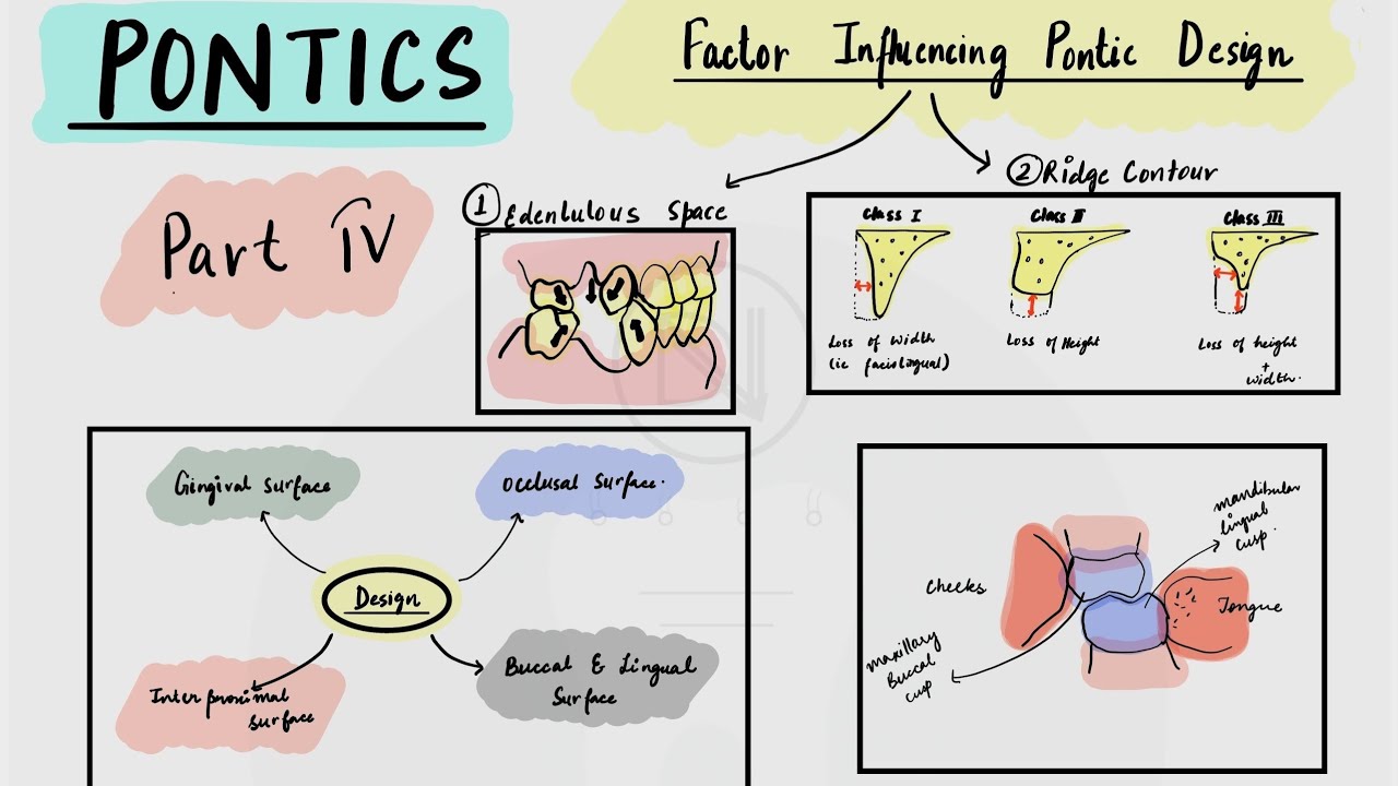 Factors influencing pontic design (Pontics in FPD - Part4)