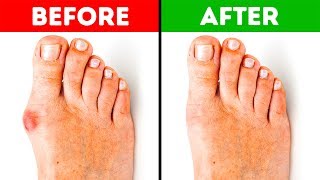 5 Effective Ways to Get Rid of Bunions
