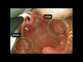 Laryngoscopy Education Video