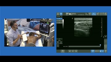 Transverse In-Plane Approach to Thoracic Paravertebral Block