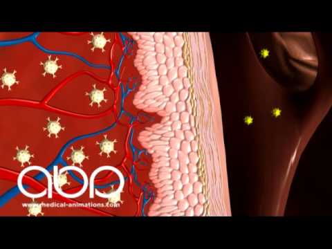 Anaphylaxis - YouTube