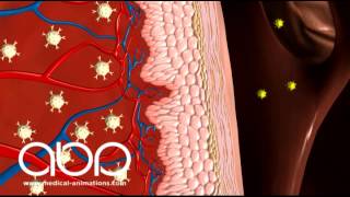 Anaphylaxis