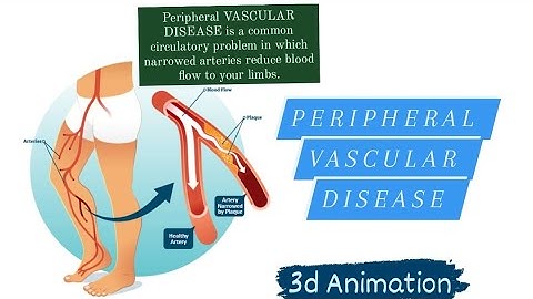 PERIPHERAL VASCULAR DISEASE | 3D ANIMATION